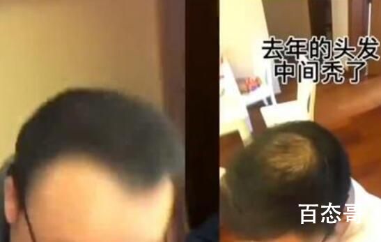 男子回应“不用洗发水变满头黑发”  用清水洗头发和头皮上的油脂头皮屑和灰尘如何去除？