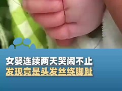 女婴两天哭闹不止竟因头发丝绕脚趾 具体来龙去脉是什么？